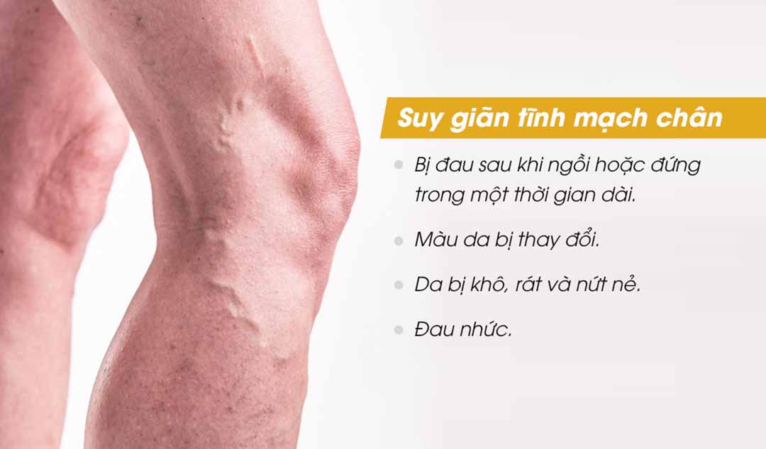 Làm thế nào để biết được suy giãn tĩnh mạch chân gây nên hiện tượng chân sưng tấy?