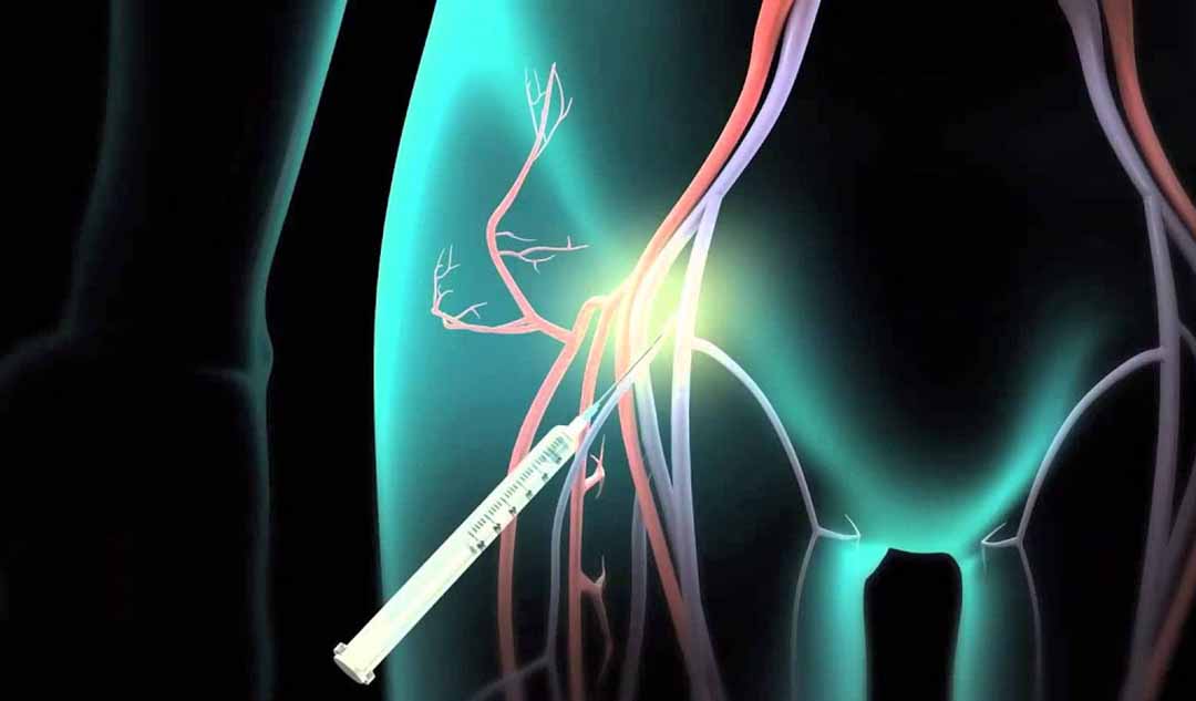 Phương pháp Đốt điện (Catheter Ablation) là gì?