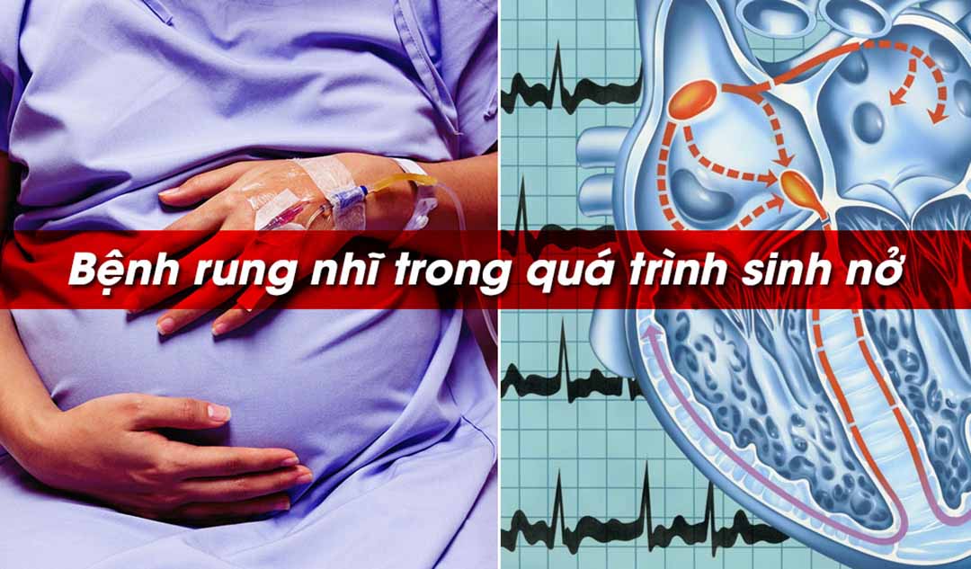 Bệnh Rung nhĩ ảnh hưởng quá trình sinh nở của người bệnh như thế nào?