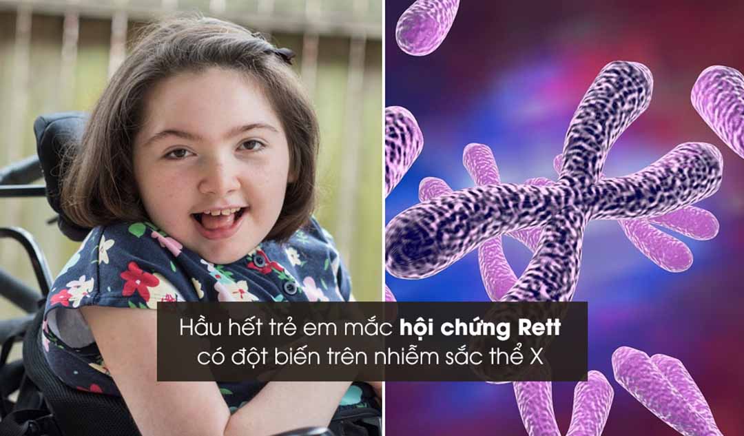 Điều gì gây ra hội chứng Rett?