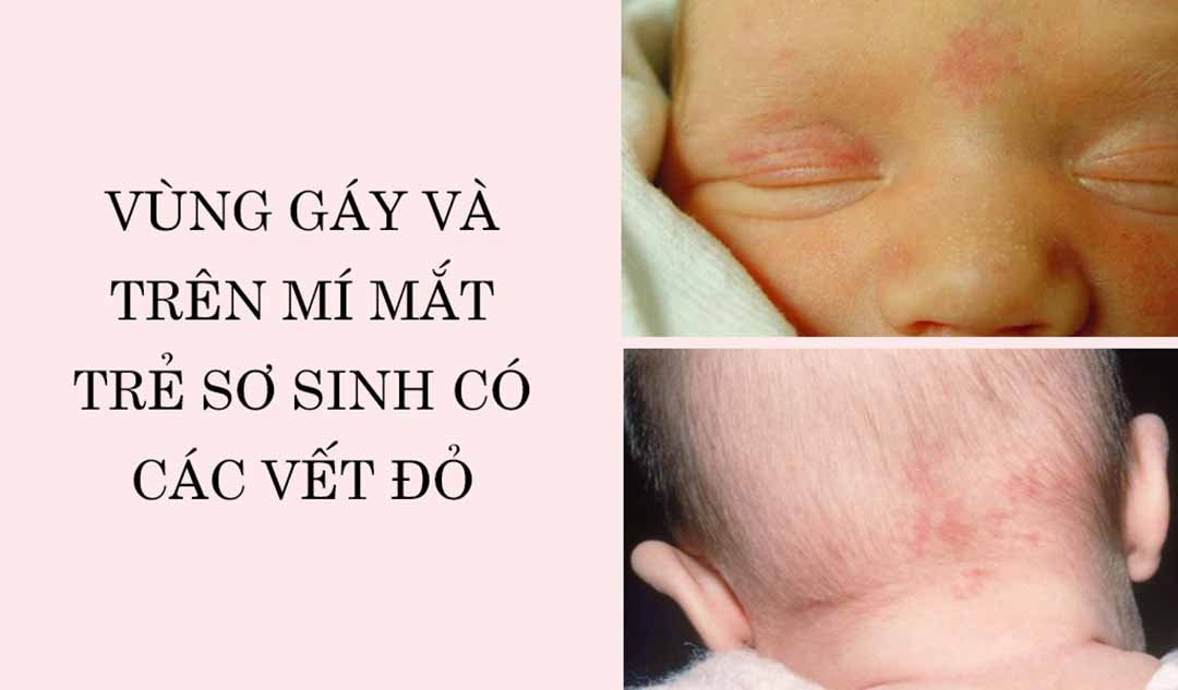 Ở vùng gáy và trên mí mắt đứa con sơ sinh của tôi có các vết đỏ. Khi nào thì chúng sẽ mất đi?