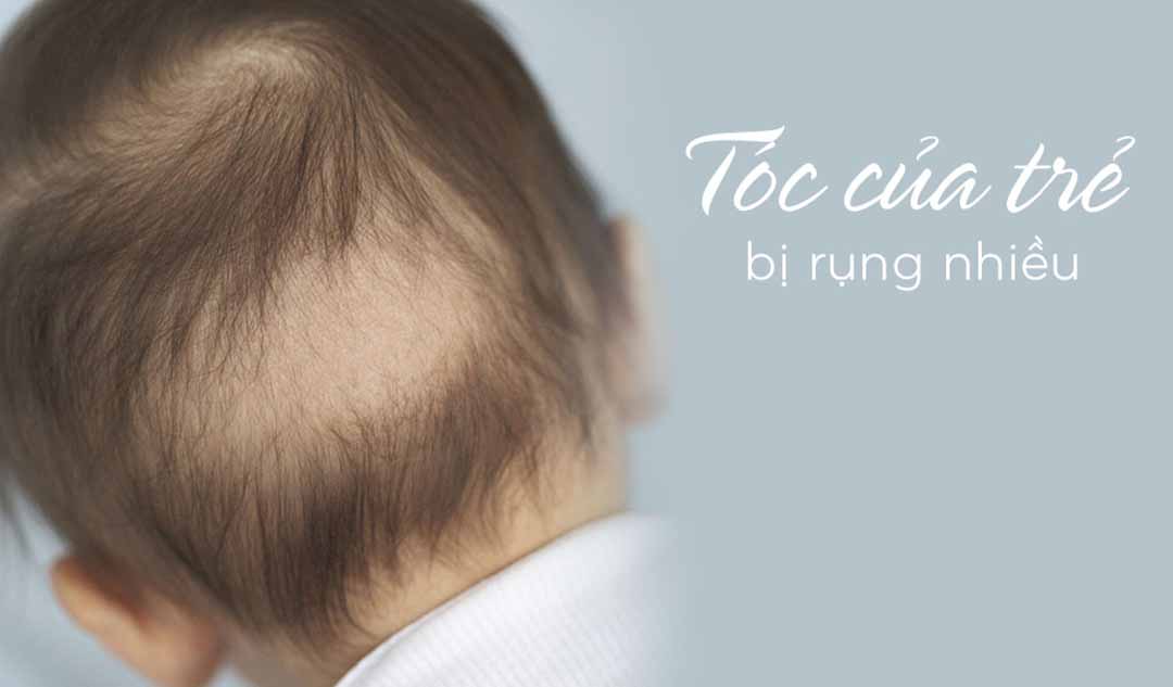 Tóc của con tôi gần đây bị rụng nhiều. Điều đó có bình thường không? Nguyên nhân có phải là thiếu vitamin không?