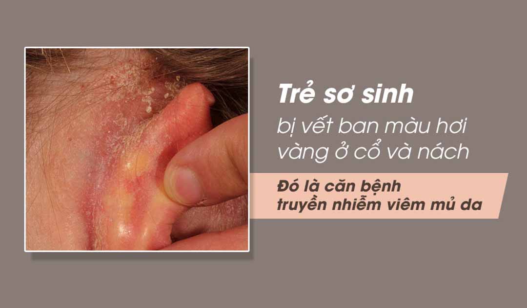 Đứa con 9 tháng của tôi bị các vết ban màu hơi vàng ở cổ và nách. Điều đó có bình thường không?