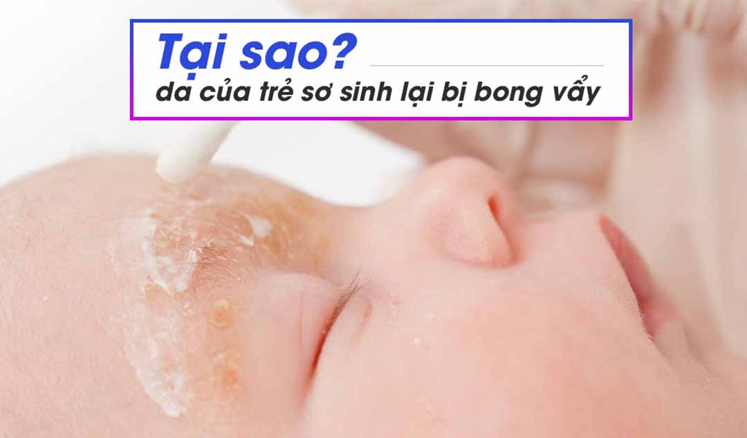 Tại sao da của trẻ sơ sinh lại bị bong vẩy?