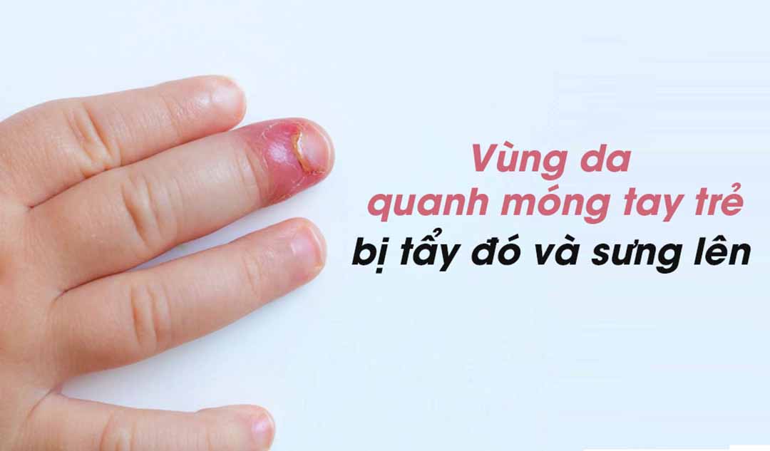 Vùng da xung quanh móng tay của con tôi bị tấy đỏ và sưng lên. Liệu có nguy hiểm không?