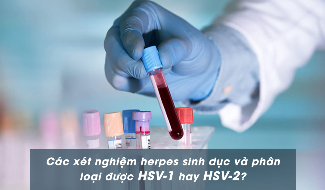 Các xét nghiệm herpes sinh dục và phân loại được HSV-1 hay HSV-2?