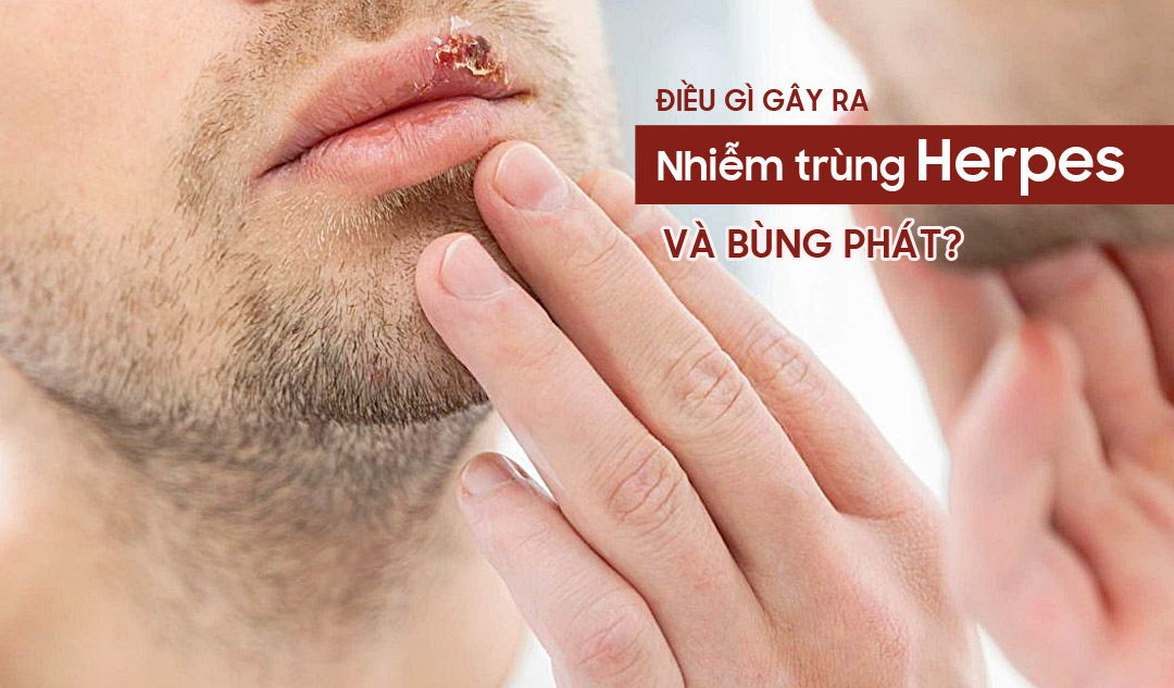 Điều gì gây ra nhiễm trùng herpes và bùng phát?