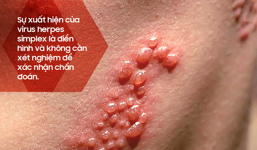 Làm thế nào là herpes simplex được chẩn đoán?