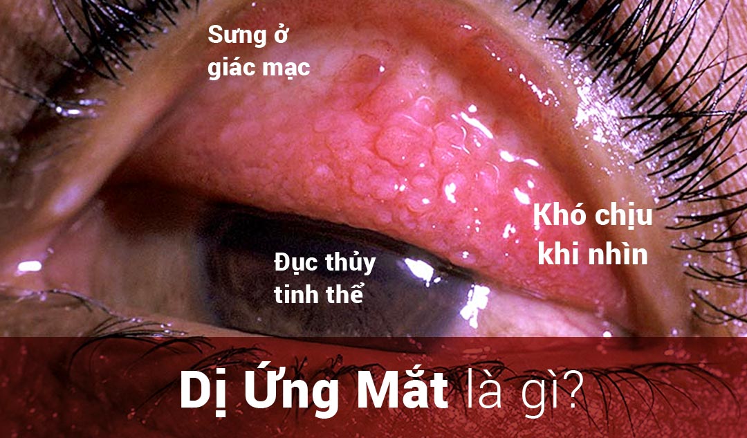 Tình trạng bị dị ứng mắt là gì?