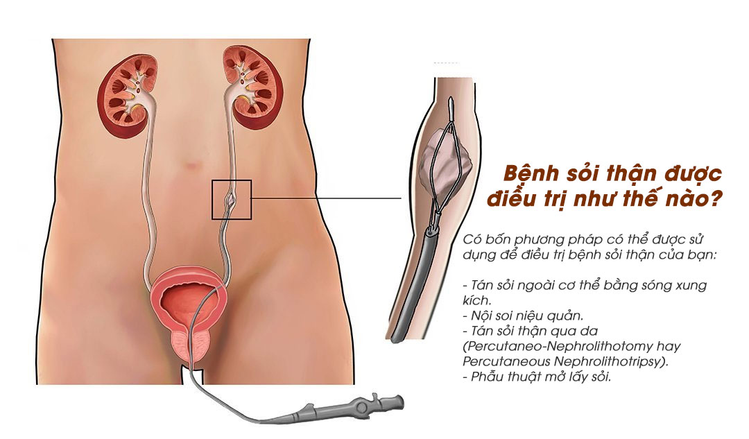  Bệnh sỏi thận được điều trị như thế nào?