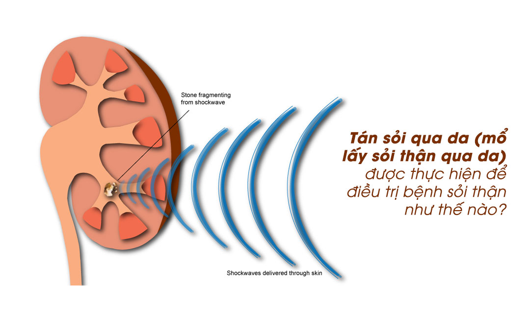 Tán sỏi qua da (mổ lấy sỏi thận qua da) được thực hiện để điều trị bệnh sỏi thận như thế nào?