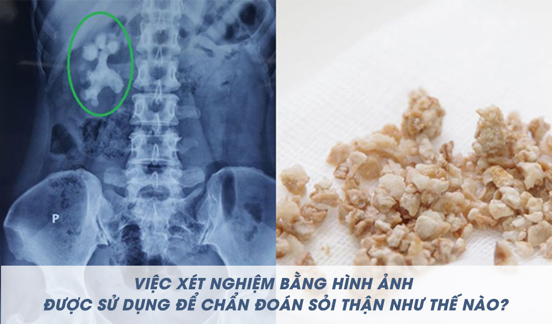 Việc xét nghiệm bằng hình ảnh được sử dụng để chẩn đoán sỏi thận như thế nào?