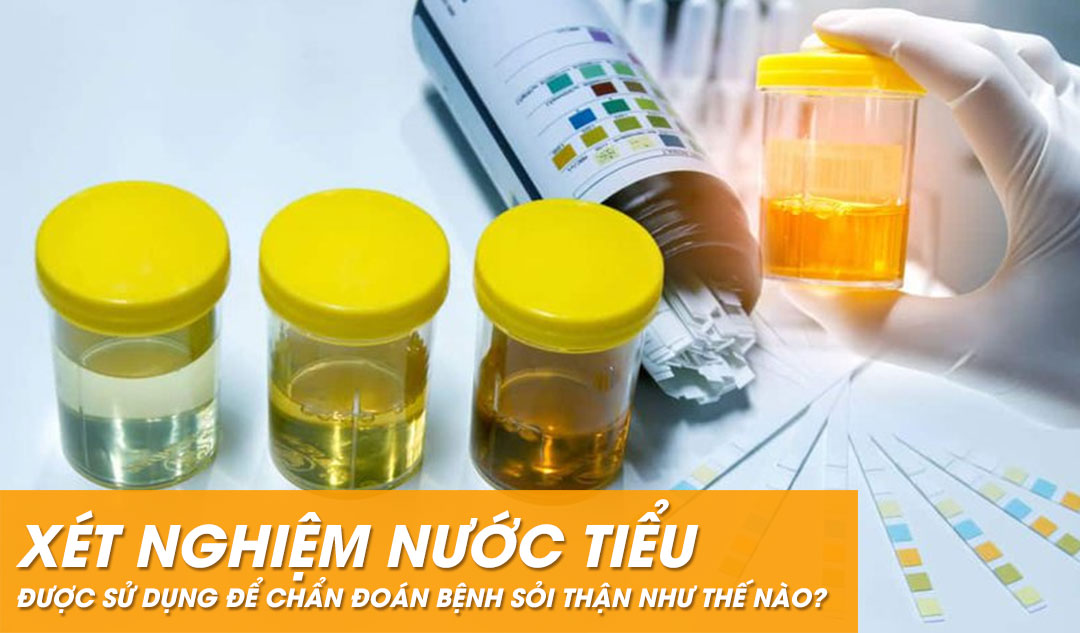 Xét nghiệm nước tiểu được sử dụng để chẩn đoán bệnh sỏi thận như thế nào?