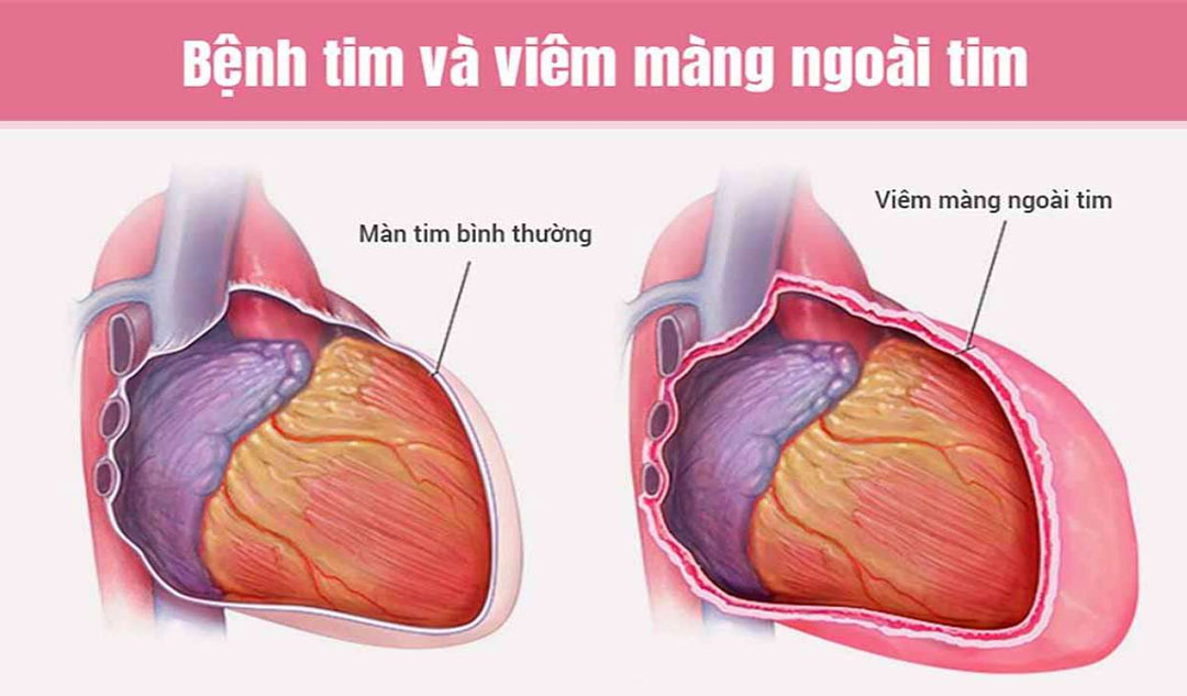 Viêm màng ngoài tim co thắt là gì?