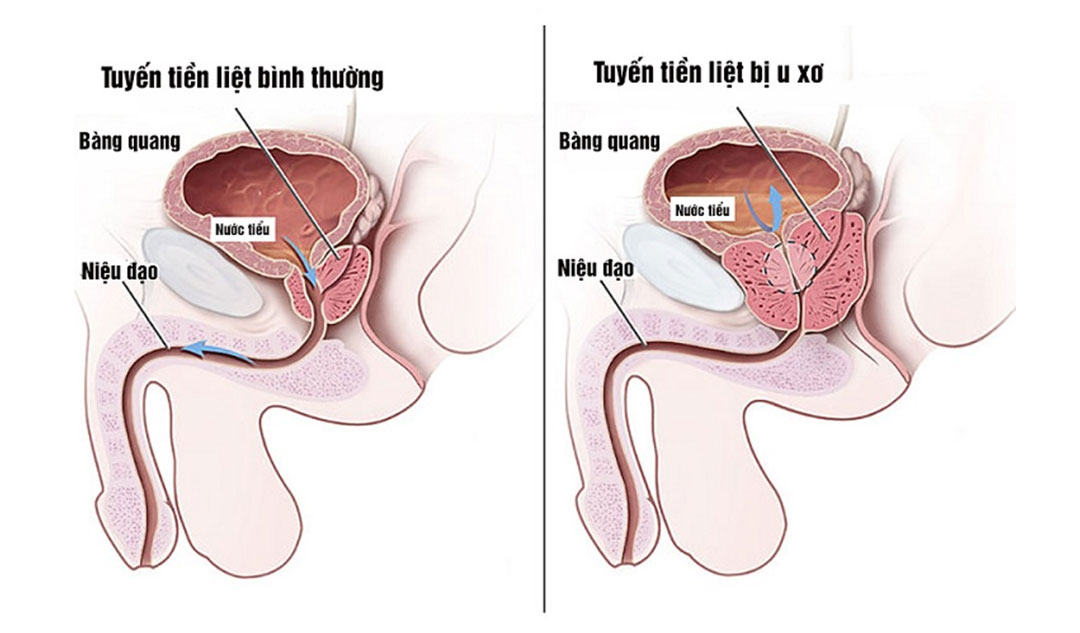 Độ tuổi nào ở đàn ông thường mắc phải u xơ tuyến tuyền liệt?