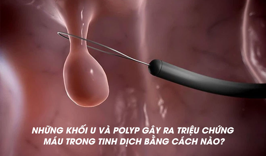 Những khối u và polyp gây ra triệu chứng máu trong tinh dịch bằng cách nào?