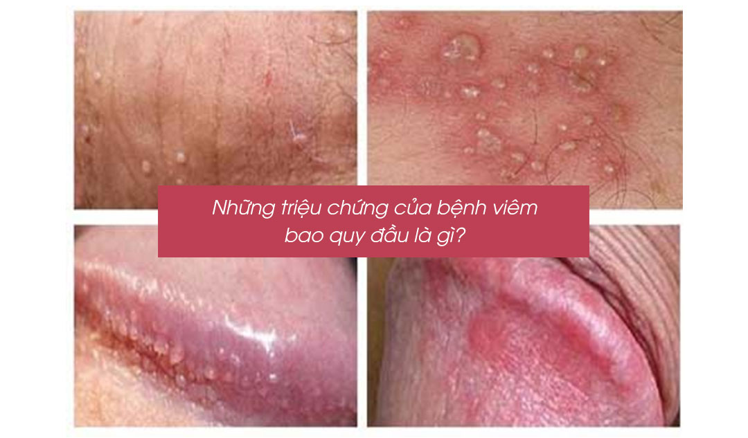 Những triệu chứng của bệnh viêm bao quy đầu là gì?