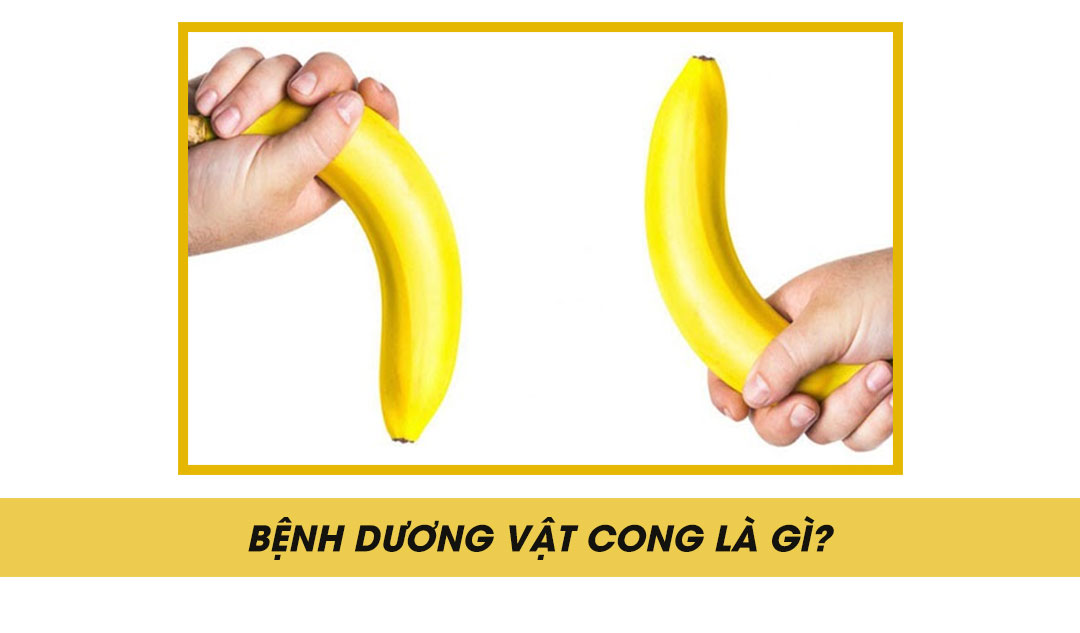 Bệnh dương vật cong là gì?