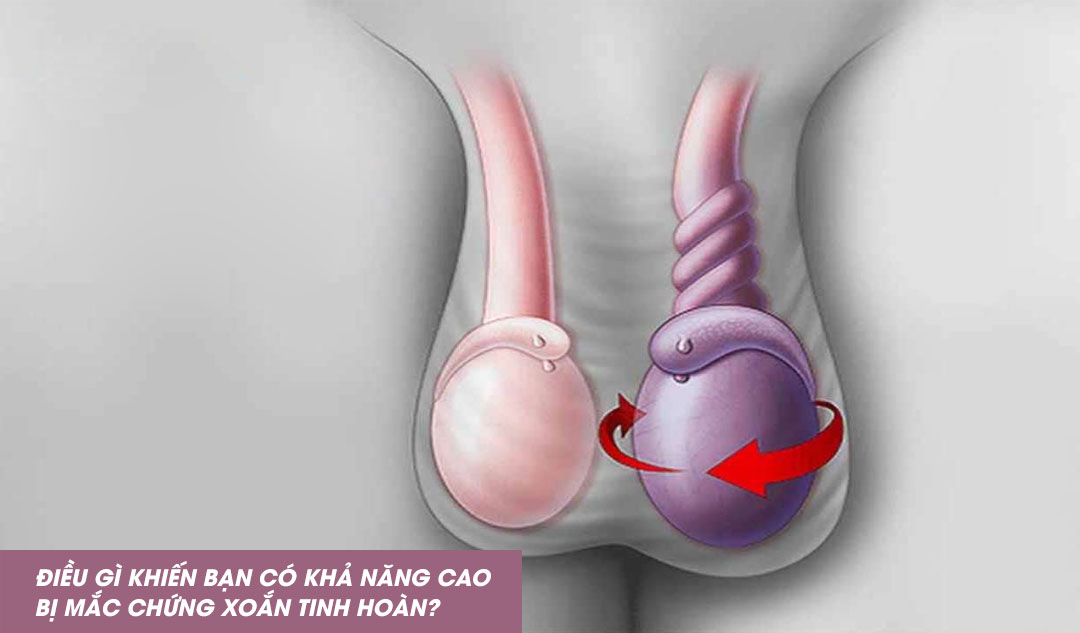 Điều gì khiến bạn có khả năng cao bị mắc chứng xoắn tinh hoàn?