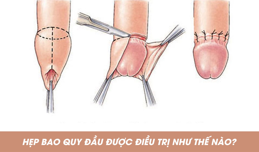 Hẹp bao quy đầu được điều trị như thế nào?