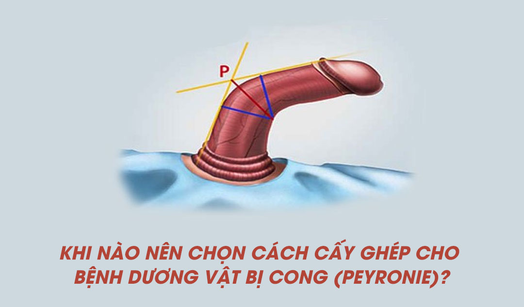 Khi nào nên chọn cách cấy ghép cho bệnh dương vật bị cong (Peyronie)?