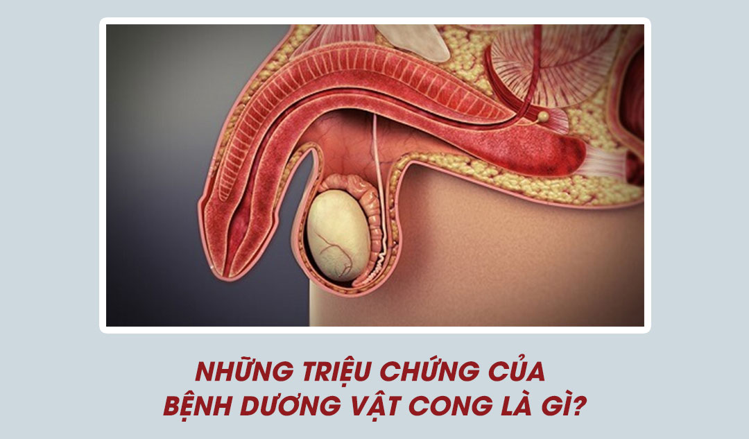 Những triệu chứng của bệnh dương vật cong là gì?