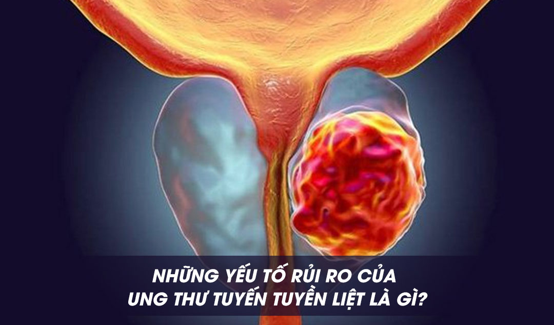 Những yếu tố rủi ro của ung thư tuyến tuyền liệt là gì?