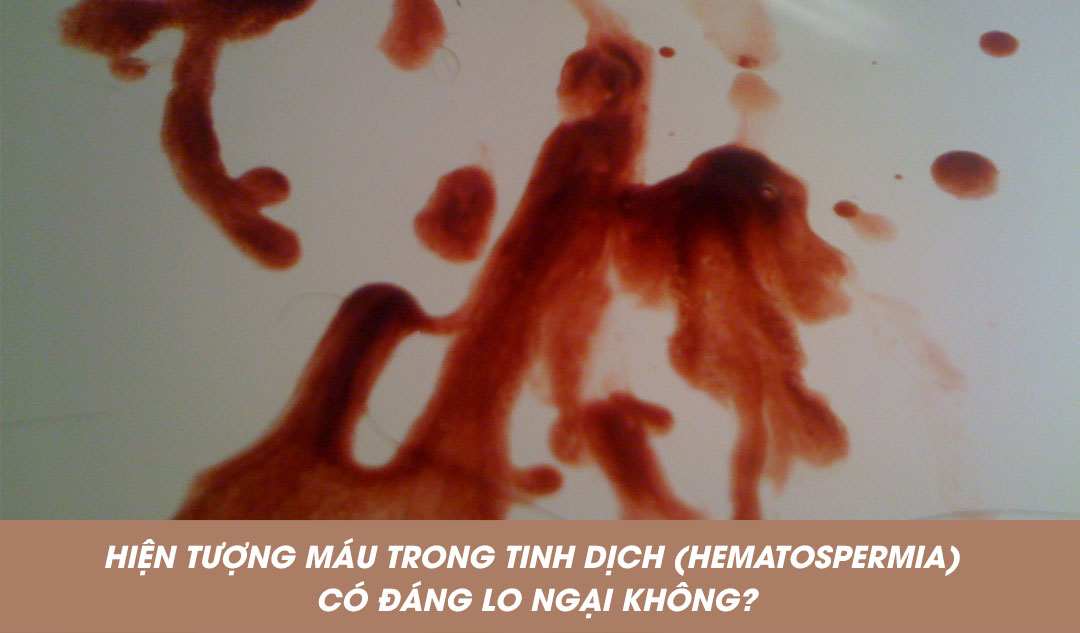 Hiện tượng máu trong tinh dịch (hematospermia) có đáng lo ngại không?