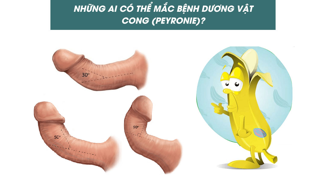 Những ai có thể mắc bệnh dương vật cong (Peyronie)?