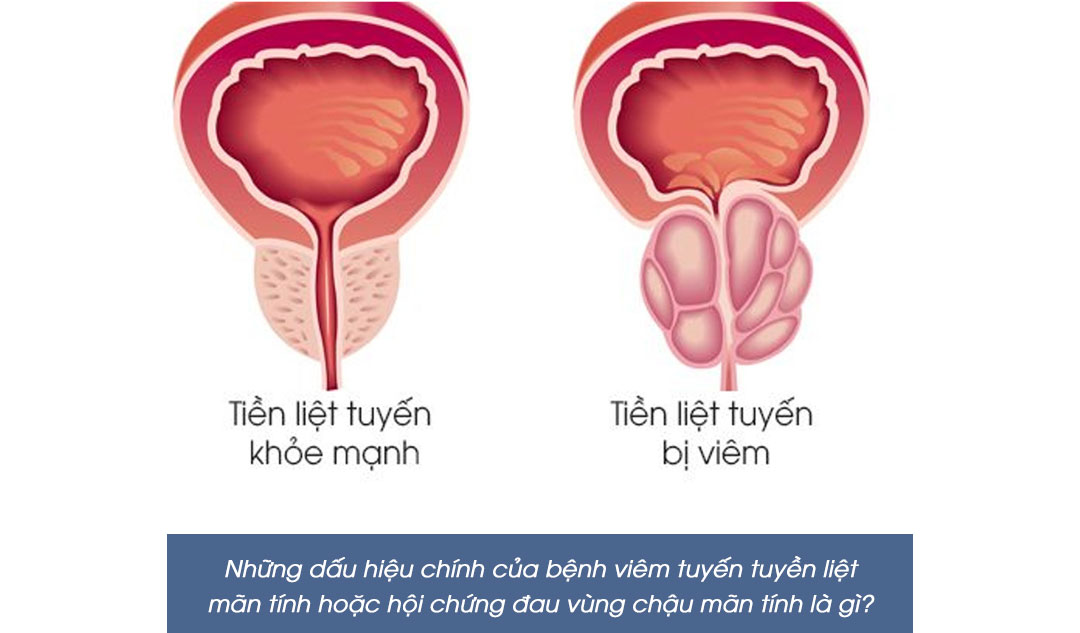 Những dấu hiệu chính của bệnh viêm tuyến tuyền liệt mãn tính hoặc hội chứng đau vùng chậu mãn tính là gì?