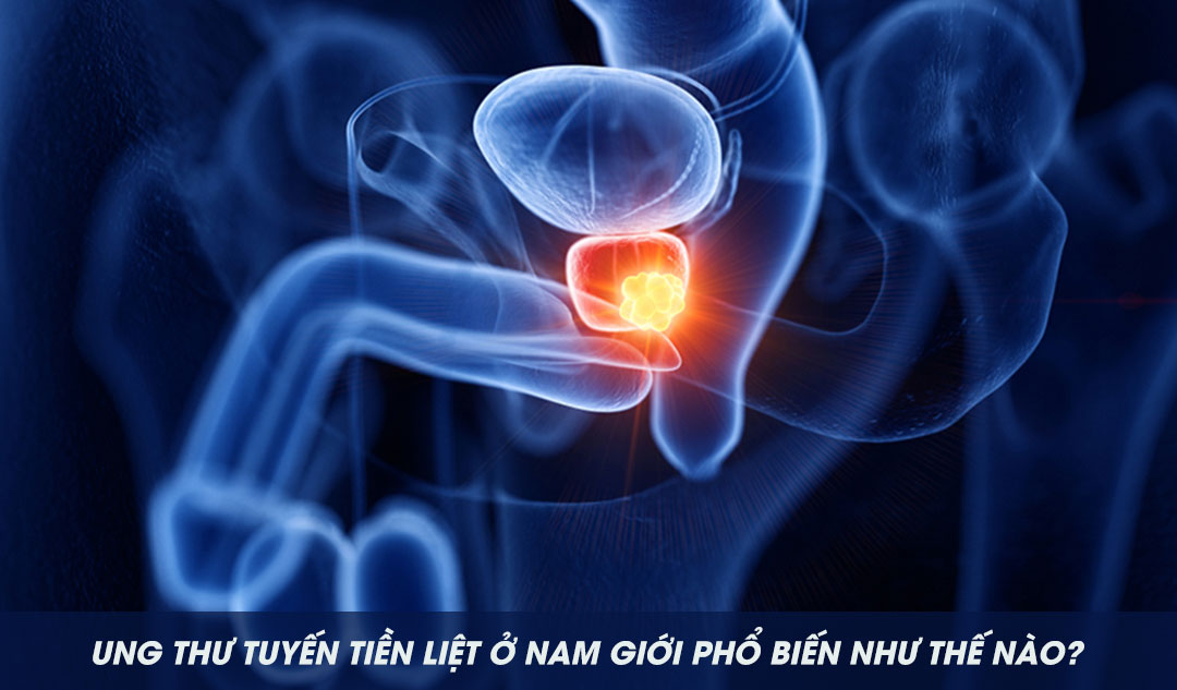 Ung thư tuyến tiền liệt ở nam giới phổ biến như thế nào?