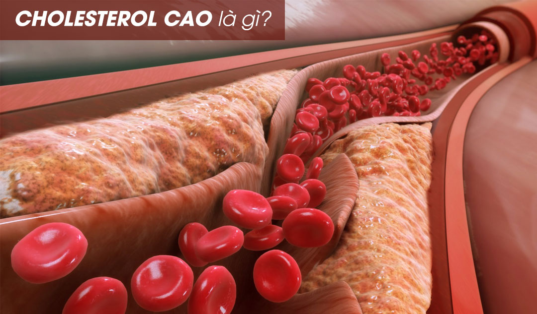 Cholesterol cao là gì?