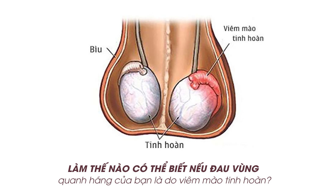 Làm thế nào có thể biết nếu đau vùng quanh háng của bạn là do viêm mào tinh hoàn?