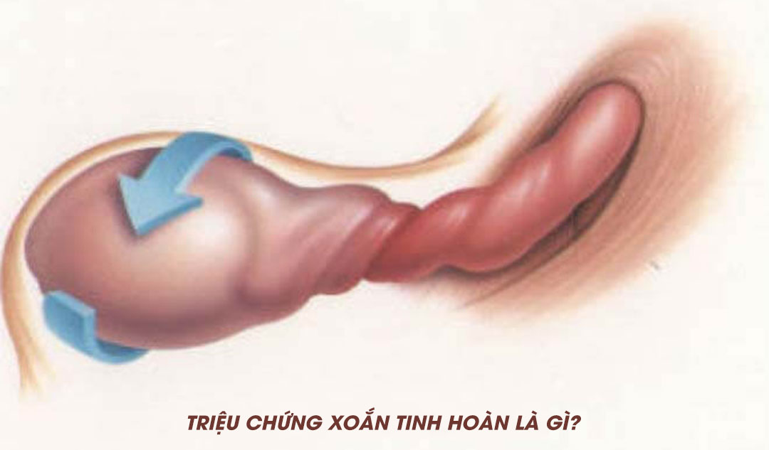 Triệu chứng xoắn tinh hoàn là gì?