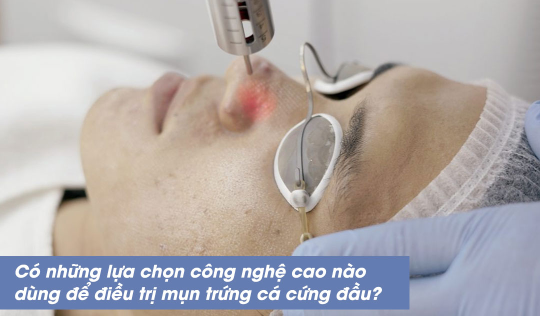 Có những lựa chọn công nghệ cao nào dùng để điều trị mụn trứng cá cứng đầu?