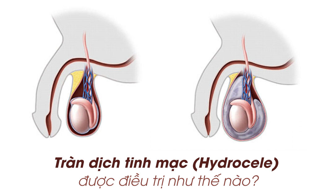 Tràn dịch tinh mạc (Hydrocele) được điều trị như thế nào?