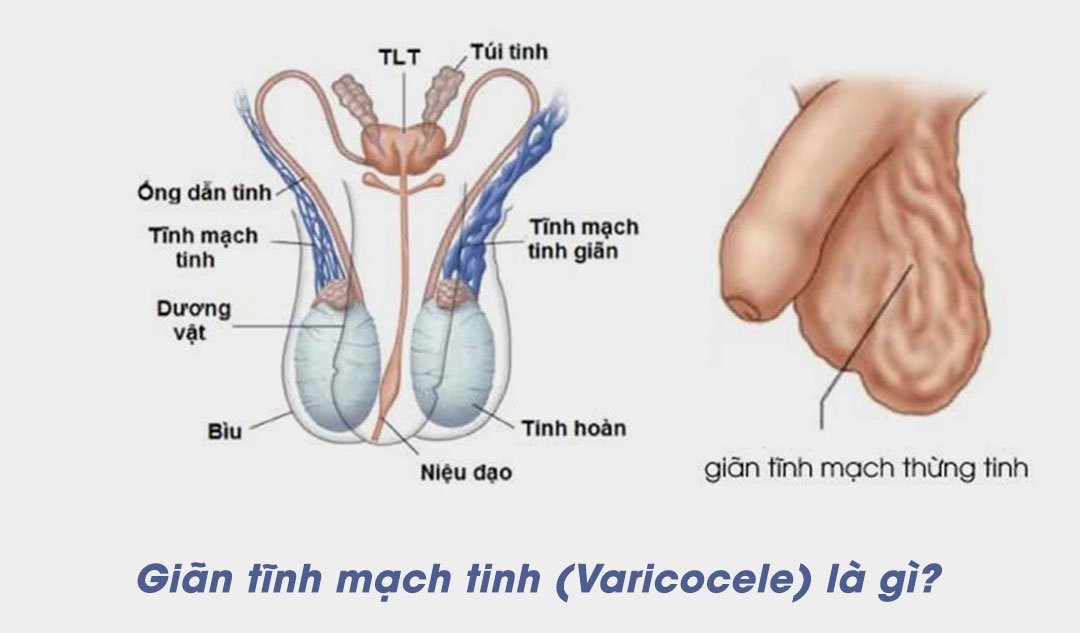 Giãn tĩnh mạch tinh (Varicocele) là gì?