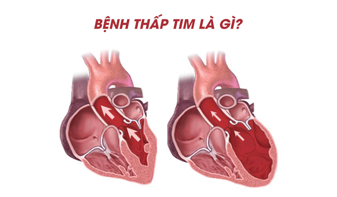 Bệnh thấp tim là gì?