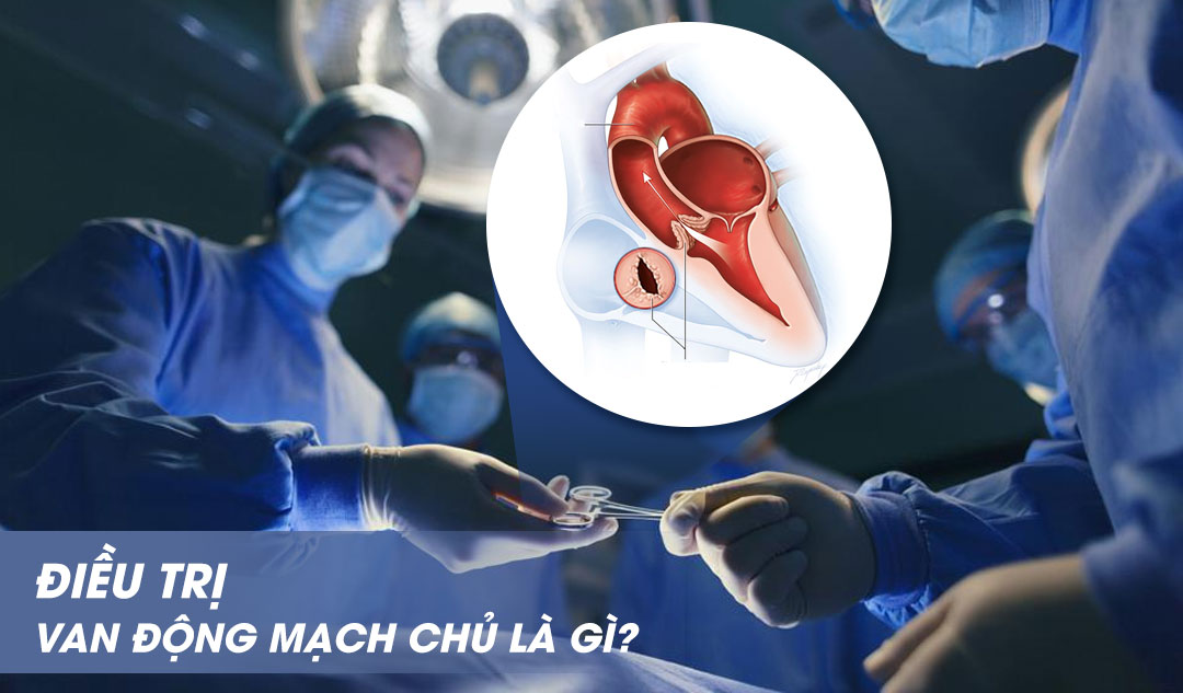 Điều trị van động mạch chủ là gì?