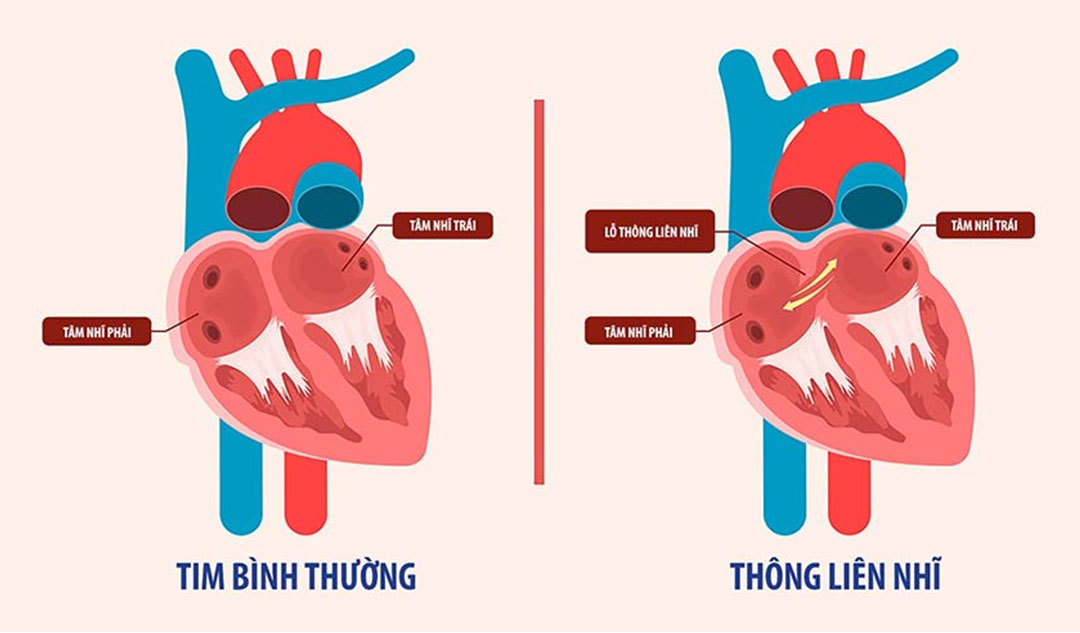 Định nghĩa của thông liên nhĩ là gì?