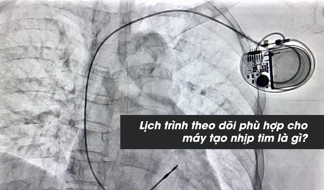 Lịch trình theo dõi phù hợp cho máy tạo nhịp tim là gì?