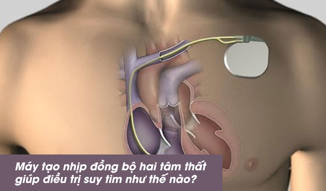 Máy tạo nhịp đồng bộ hai tâm thất giúp điều trị suy tim như thế nào?