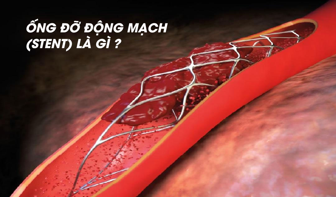 Ống đỡ động mạch (stent) là gì ?