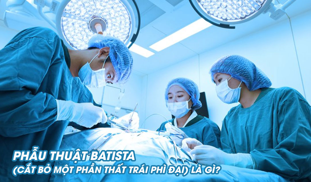 Phẫu thuật Batista (cắt bỏ một phần thất trái phì đại) là gì?