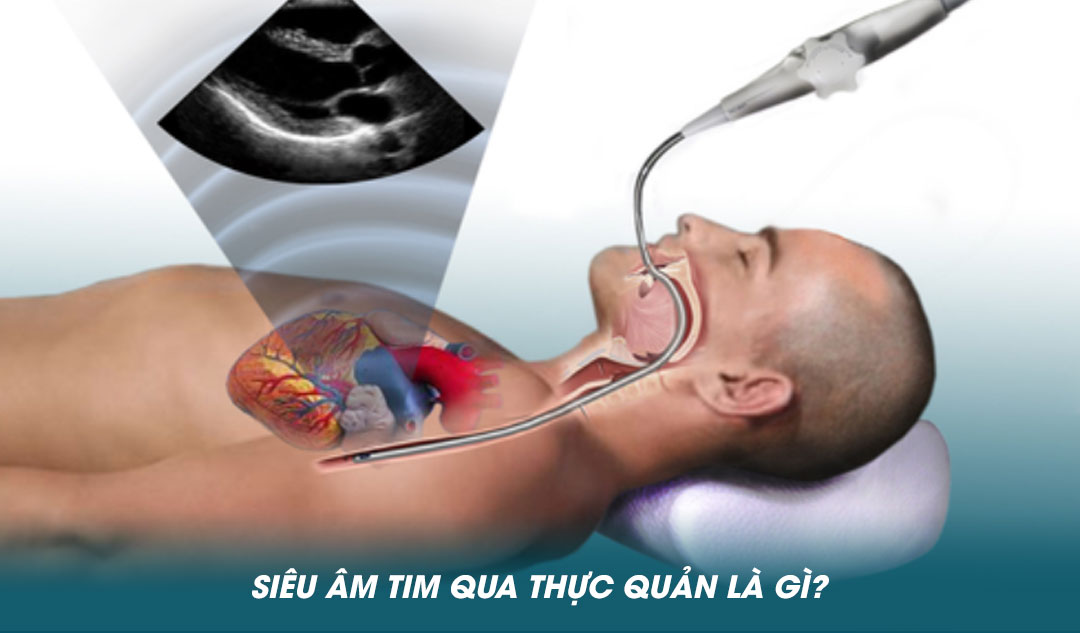 Siêu âm tim qua thực quản là gì?