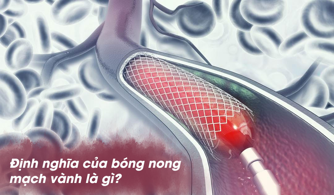 Định nghĩa của bóng nong mạch vành là gì?