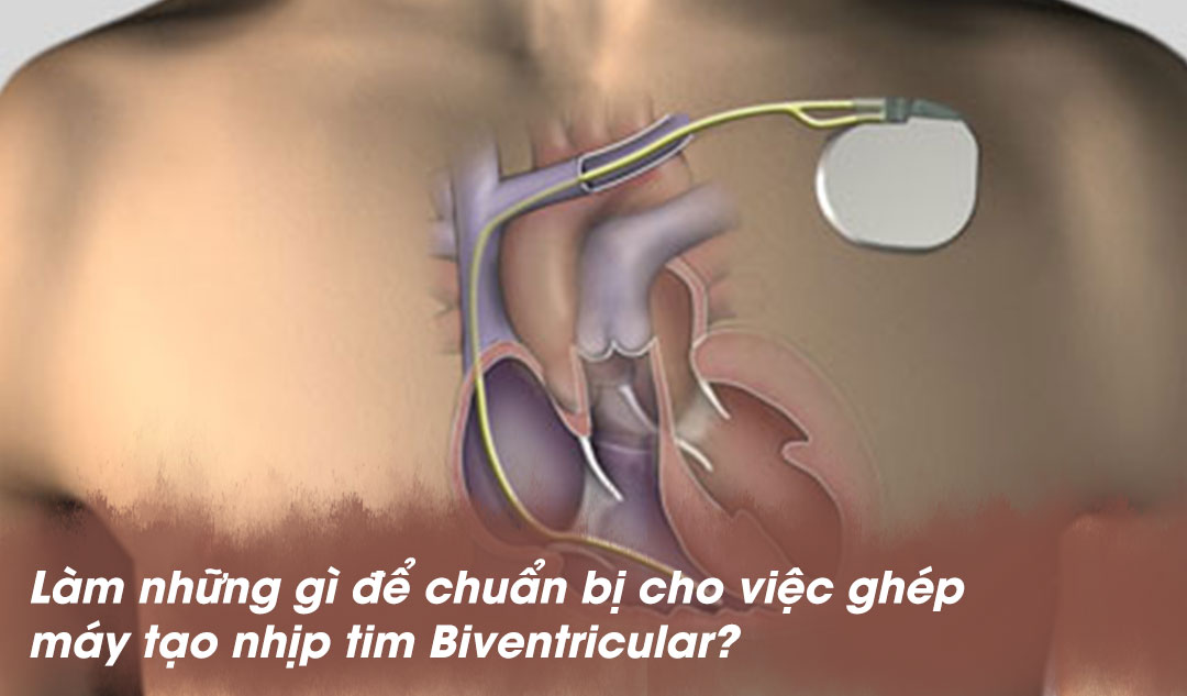 Làm những gì để chuẩn bị cho việc ghép máy tạo nhịp tim Biventricular?