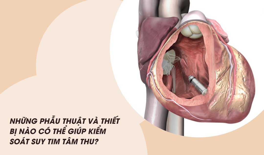 Máy tạo nhịp được cấy vào bên trong tim như thế nào?