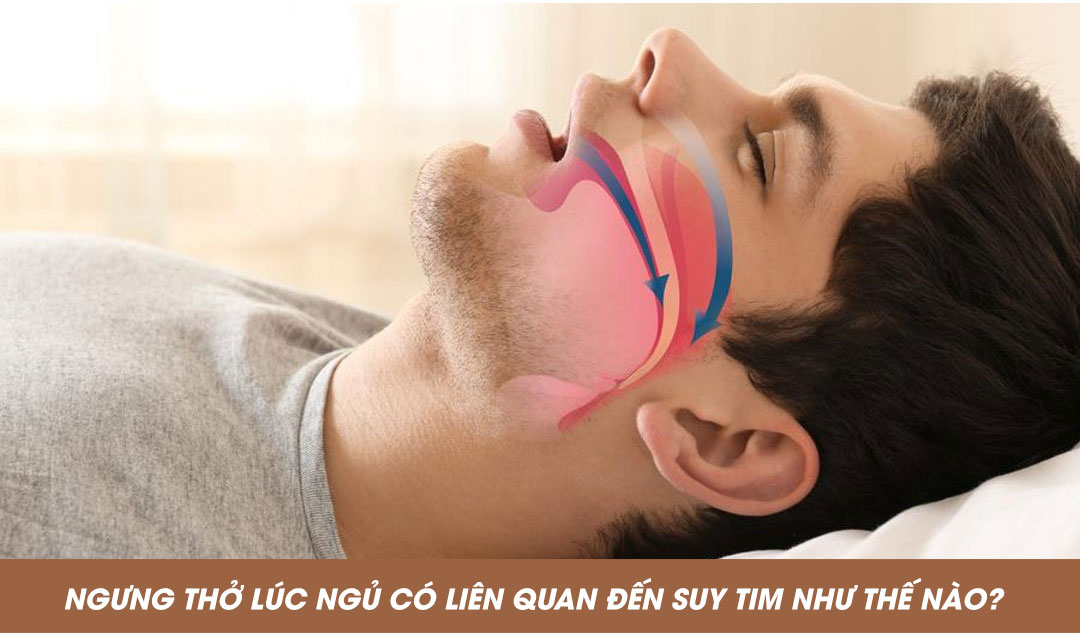 Ngưng thở lúc ngủ có liên quan đến suy tim như thế nào?