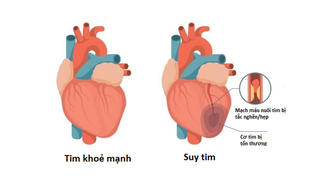 Sự khác biệt giữa tim của người bình thường và một người bị suy tim là gì?